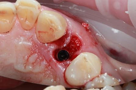 Klinische Anwendung von OssaBase-HA im Knochendefekt