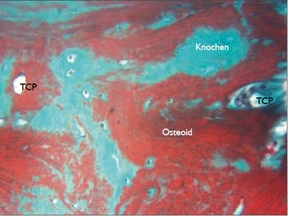 Histologischer Schnitt: Knochenneubildung mit PORESORB-TCP