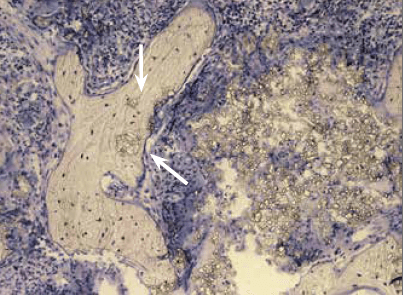 Histologischer Schnitt: PORESORB-TCP im Resorptionsverlauf